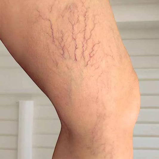 Arañas vasculares: qué son, síntomas y tratamiento?