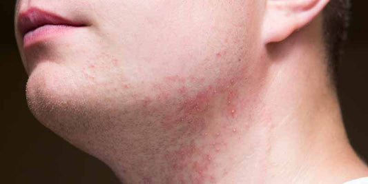 ¿Cómo Eliminar la Irritación por Afeitado?